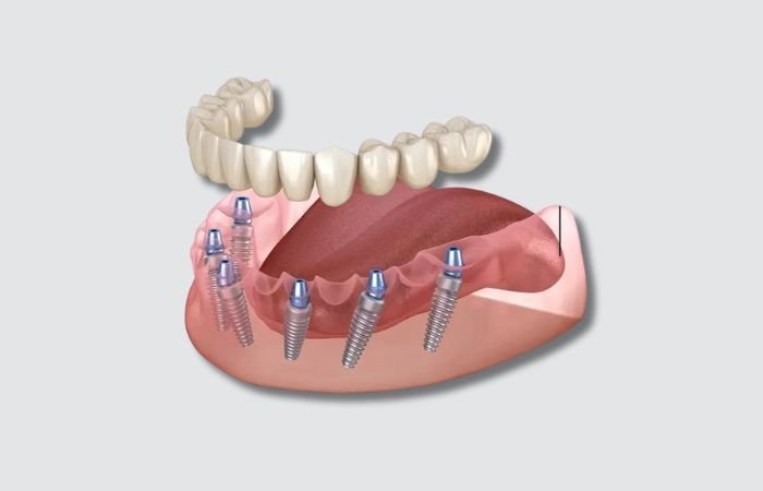 Implants vs Dentures Visual