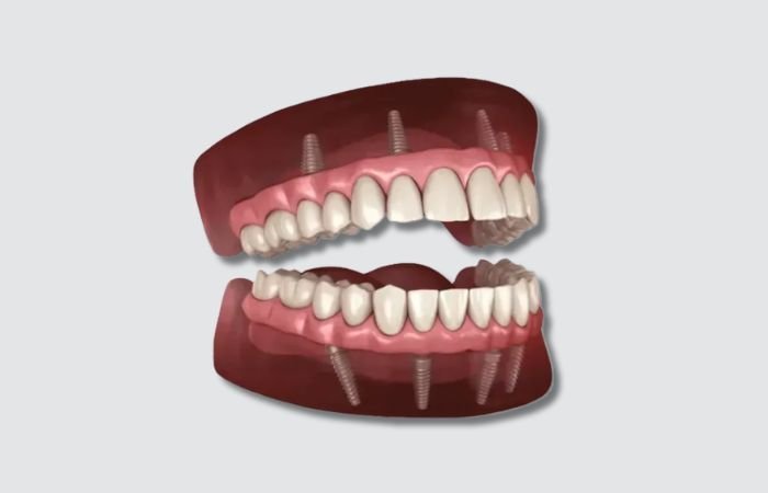 Full Arch Implants Visual